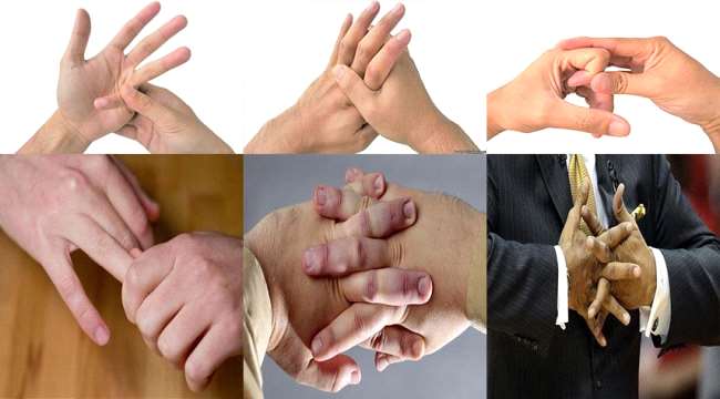 تعرف على حقيقة أضرار "طقطقة الأصابع"!! 