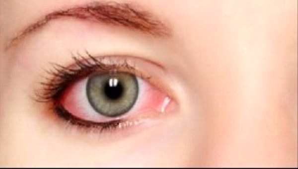 أسباب احمرار العين وعلاجها
