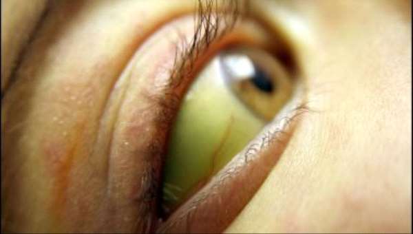 أسباب اصفرار الجلد ومشكلاته المرضية