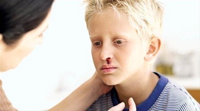 نزيف الأنف لدى الأطفال.. أسبابه وكيفية مواجهته