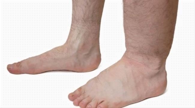 5 أسباب لاحتباس السوائل داخل الجسم وطرق العلاج