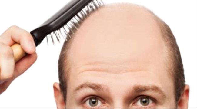 للسيدات والرجال لو عندك مشكلة الصلع.. اعرف السبب وطرق العلاج