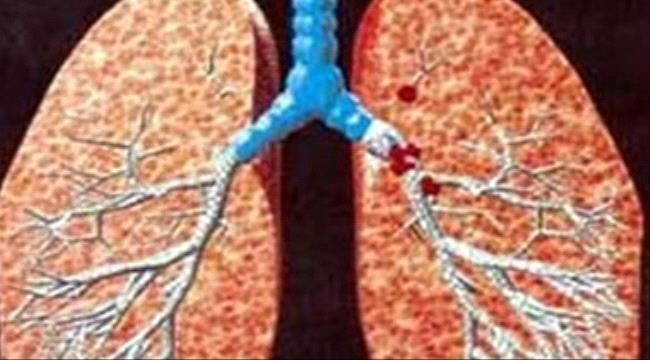 اعراض الالتهاب الرئوى وأسبابه