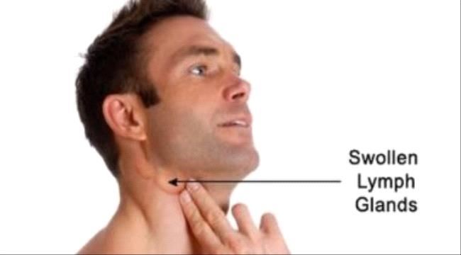 لماذا يحدث تورم فى الغدد الليمفاوية؟