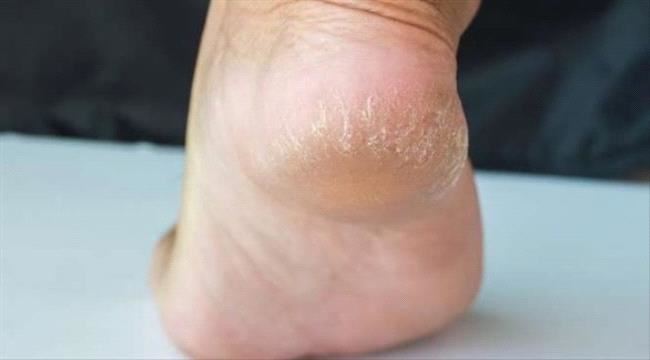 علاجات طبيعية لتشقق الكعبين أثبتت فاعليتها