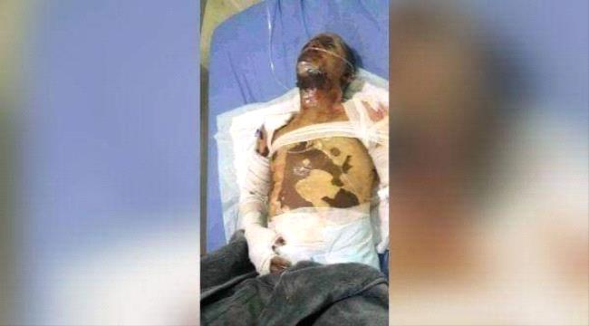 اب:وفاة بائع الايسكريم بعد اشعاله النار في جسده قبل اسبوع بسبب عدم حصوله على اسطوانة غاز