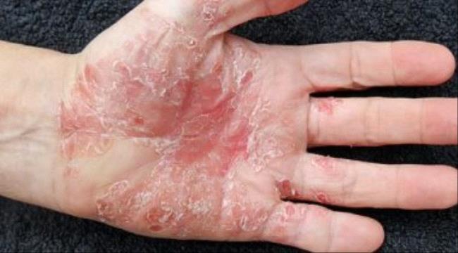 صحتك فى وصفة..الخيار والجزر والصبار لعلاج الصدفية