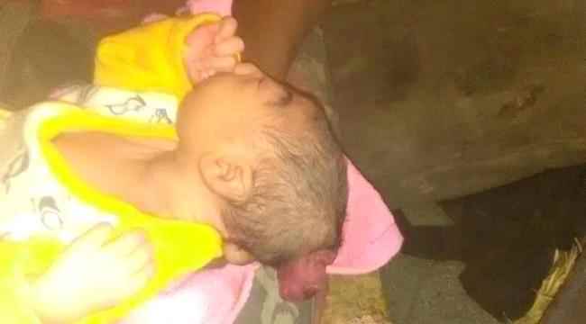 ولادة طفل بزائدة لحمية في الرأس بلحج