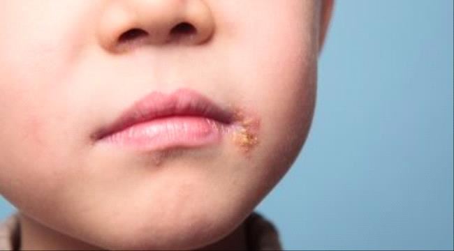 6 طرق طبيعية لعلاج الهربس.. منها العسل وزيت الزيتون