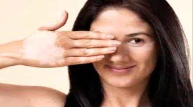 بارقة أمل لمرضى البهاق.. كريم طبي يعيد الجلد لطبيعته