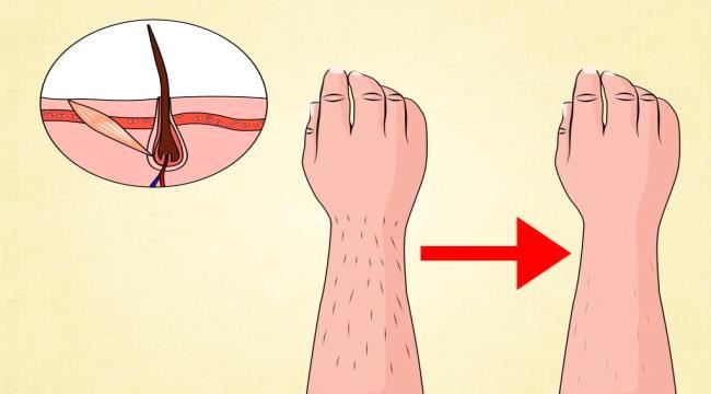 اگر بعد از لیزر موهای زائد بیرون بیاید، چگونه آن را از بین ببرم؟