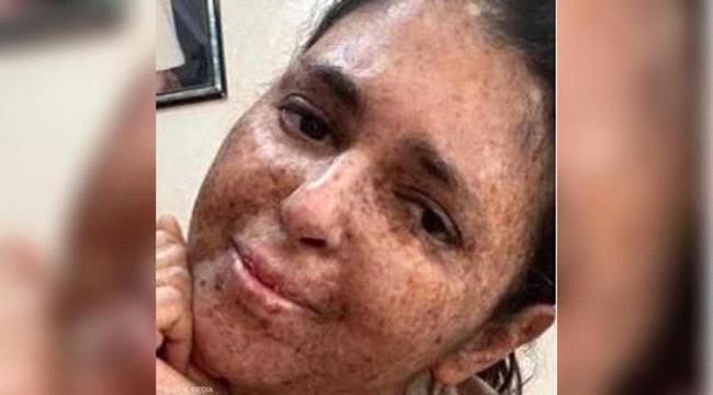 بعد وفاة "فتاة القمر".. تعرف على مرض جفاف الجلد التصبغي
