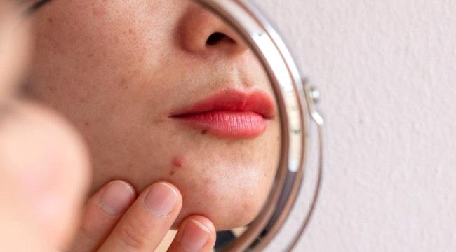 دليلك الكامل للتخلص من آثار ندبات حب الشباب