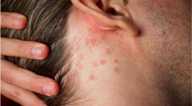 مرض الصدفية و نقص فيتامين D