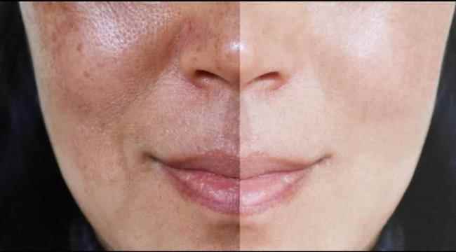 طرق لتخلص من ظهور الكلف مع التقدّم في السنّ