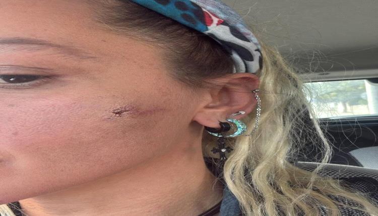 فضيحة جديدة: نجمة تركية ضحية العنف الزوجي… والجمهور يندد!