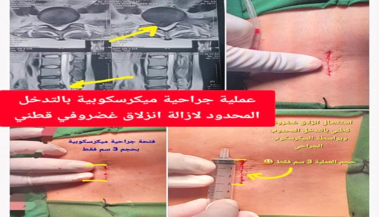 نجاح 24 عملية دقيقة للعمود الفقري في عدن خلال مايو