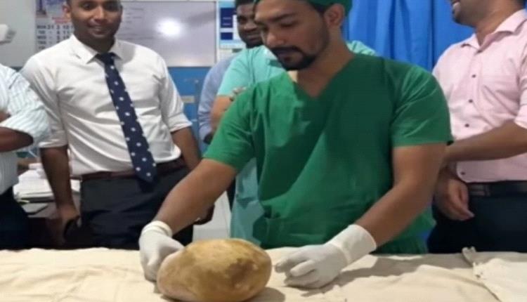 إزالة حصوة مثانة عملاقة بحجم بيضة نعامة من رجل في سريلانكا