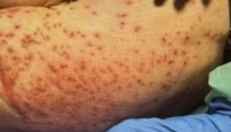 النمل الناري يقضي على سيدة أمريكية بـ1,000 لدغة