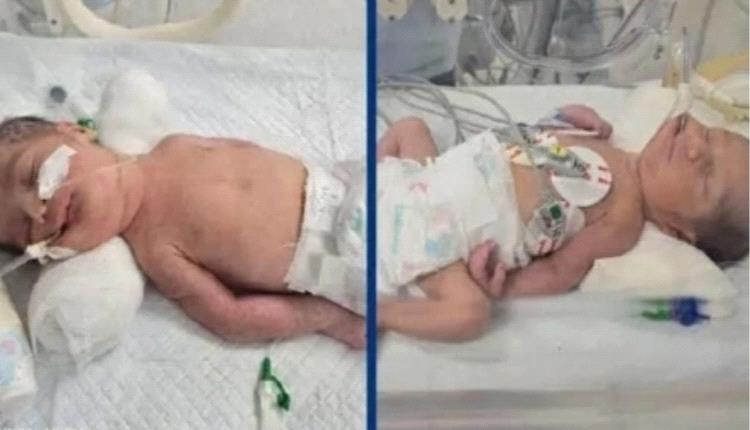 رجل ينجب توأماً من زوجته الميتة في مصر