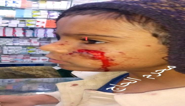 غضب واسع في تعز بعد حادثة نهش طفلة على يد كلب مسعور في المطار القديم