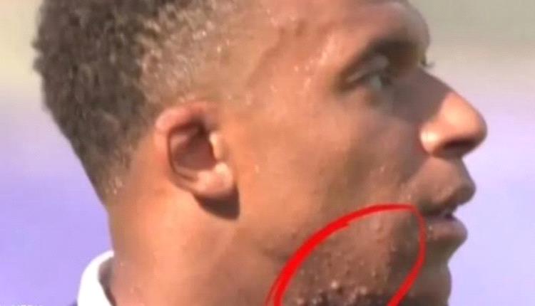 ظهور بثور على وجه النجم الفرنسي كيليان مبابي تشعل مواقع التواصل.. فما السبب وأفضل طرق العلاج؟