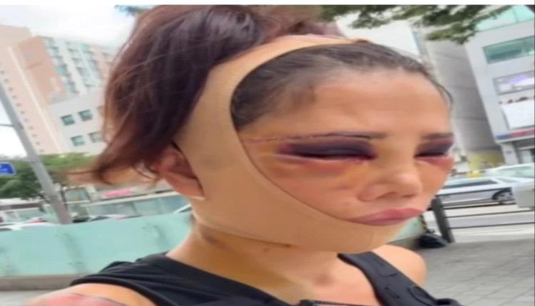 المؤثّرة التركية ديدم جيران تثير الجدل بعد عمليات تجميل في كوريا الجنوبية.. صور صادمة وتعليقات قاسية تشعل مواقع التواصل الاجتماعي