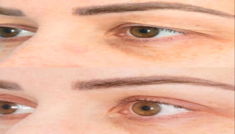 عملية قص الجفون.. مزايا للتجميل والرؤية ومخاطر لا يمكن تجاهلها