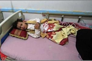 الحصبة تفتك بالمحافظات المحررة.. نحو 17 ألف إصابة و109 وفيات خلال عام 2025