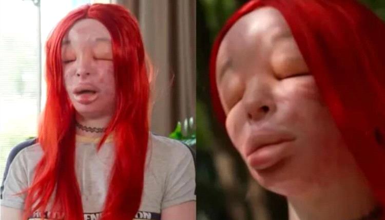هوس التجميل يدمر وجهها.. فتاة بولندية تستيقظ بوجه مشوه وعينين مغلقتين