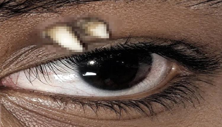 حالة نادرة.. ظهور سن في جفن مراهق هندي يحير الأطباء