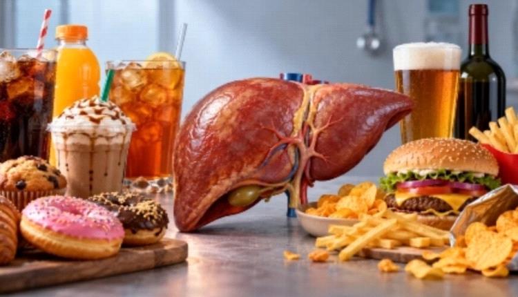 كيف تهدد المشروبات المحلاة والوجبات السريعة صحة الكبد؟