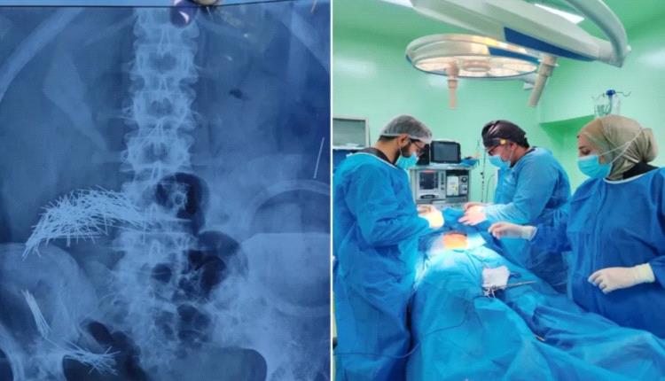 جراحة صادمة في العراق.. إخراج مئات الإبر والدبابيس من معدة مريض