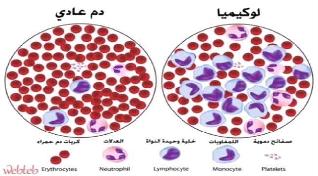 تعرف على أعراض سرطان الدم "اللوكيميا"