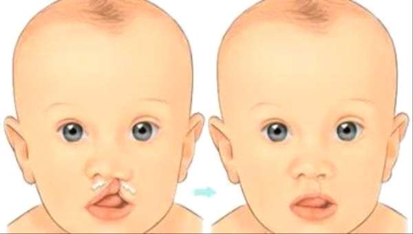 تعرف على الأسباب وراء الشفة الأرنبية لدى الأطفال؟