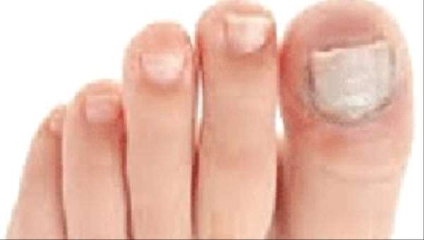 تعرف على أسباب انتشار الفطريات بين أصابع القدمين وطرق علاجها