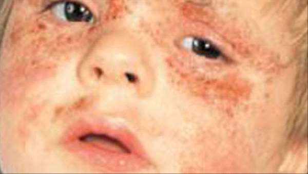 اسباب التهاب الجلد والأطعمة والمواد التى تزيد مشكلاته